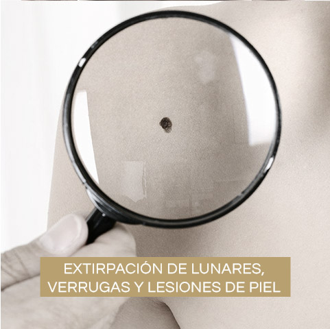Extirpación de Lunares,  Verrugas y Lesiones de Piel